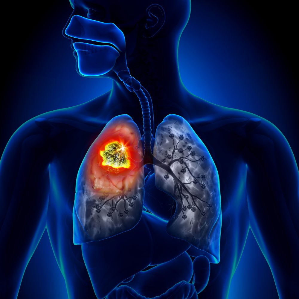 Building and Optimizing Your Lung Cancer Screening Program AABIP